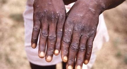 NCDC reports 40 confirmed cases of Mpox