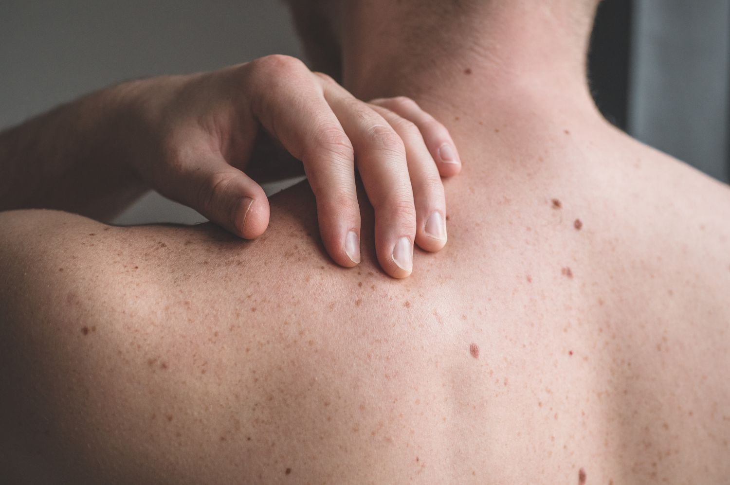 Nearly 80% of People Miss Melanoma During Skin Self-Checks, Study Finds