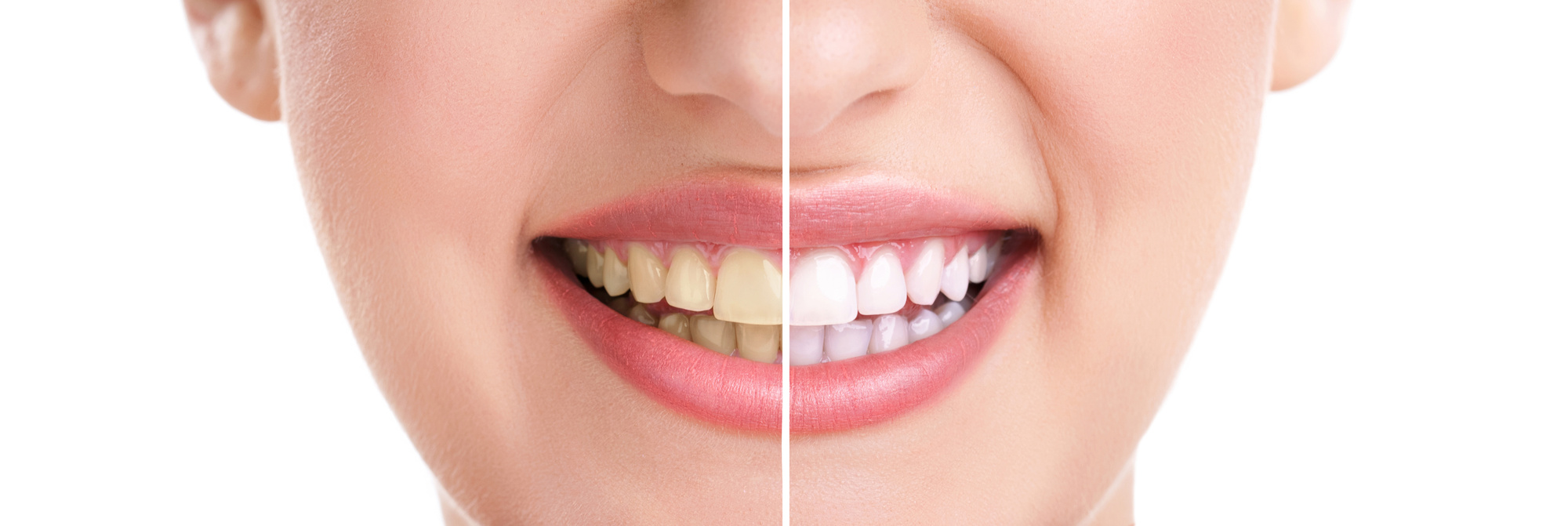 15 Benefits Of Professional Teeth Whitening