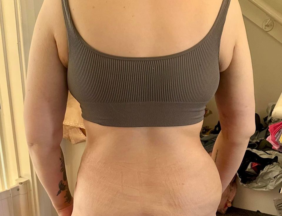 Leah feels like her body looked better before surgery - she shows her wonky hips here