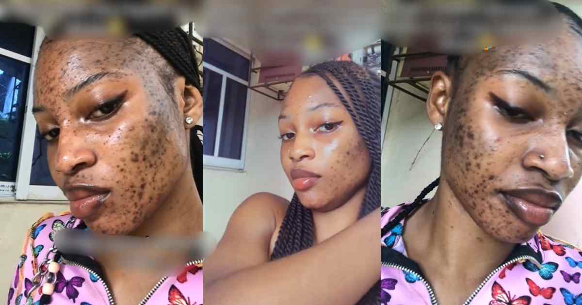 Lady develop facial rash after using skincare product heavily promoted on TikTok (WATCH)