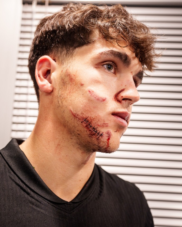 He required ten stitches in his face