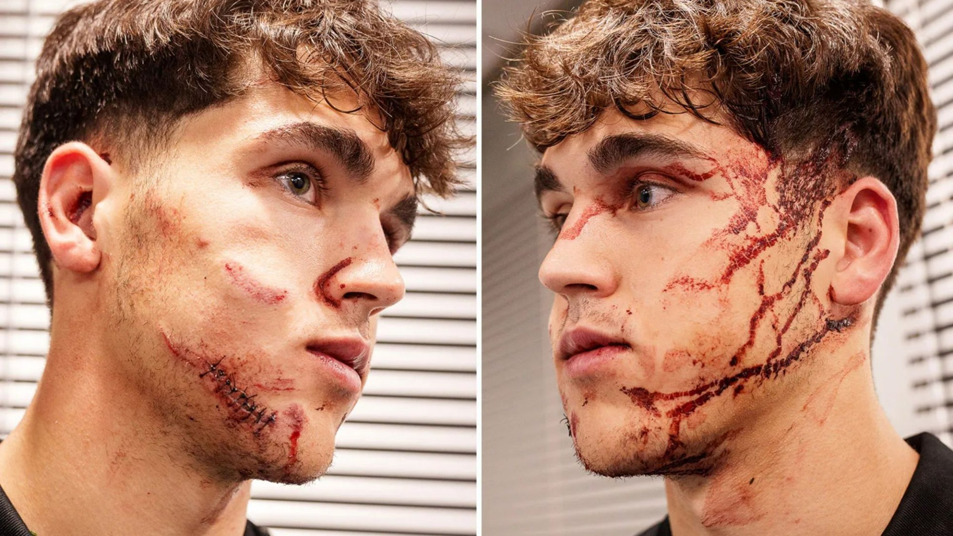 Barcelona star Pau Cubarsi shows off horror facial injuries after sickening kick to face left him needing 10 stitches