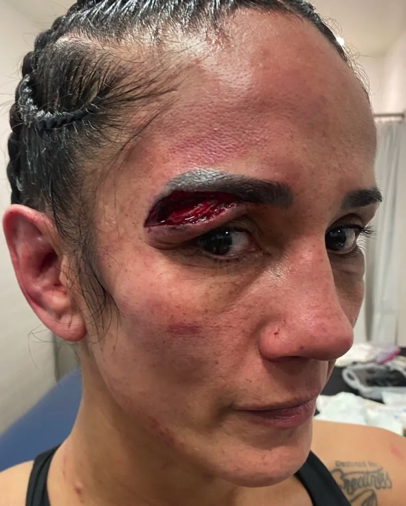 Serrano revealed the full extent of her eye injury after losing to Taylor