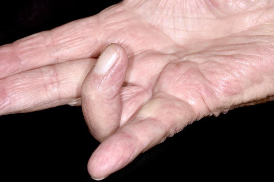 The condition can cause one or more fingers to curl towards the palm or pull sideways