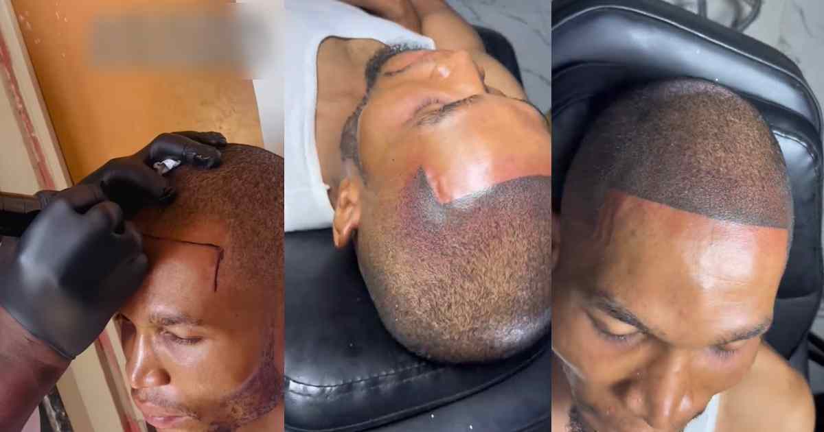 "What if he goes b@ld in old age?" – Man takes drast!c measure to define hairline, gets permanent tattoo (VIDEO)