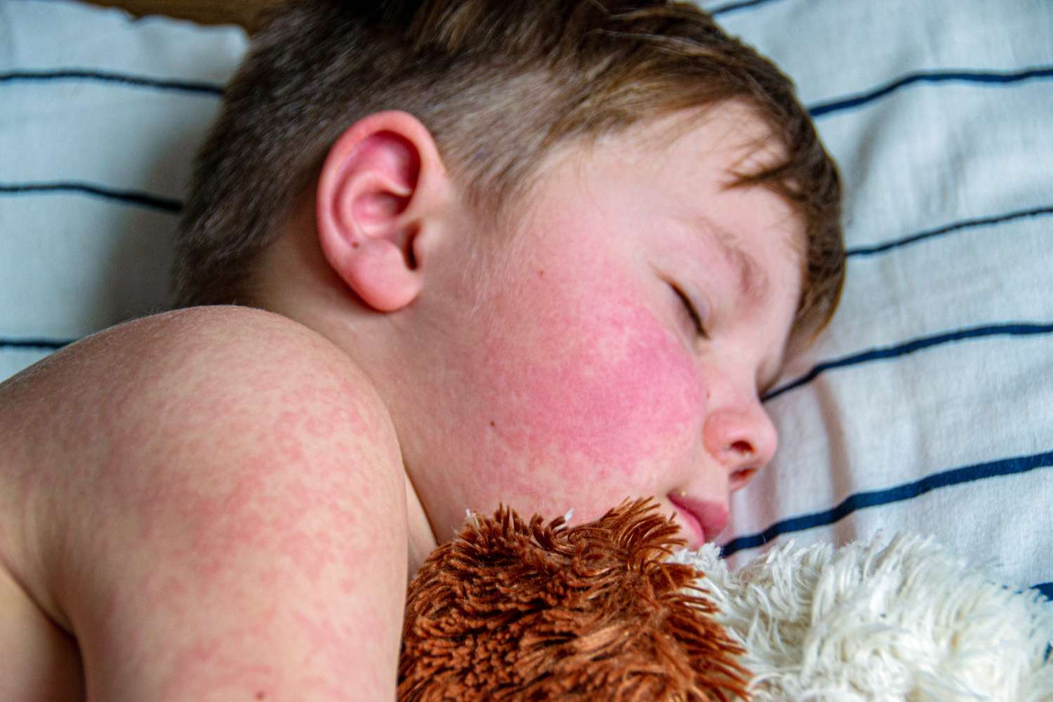 Global Measles Cases Jumped 20%. Here's How That Could Affect You