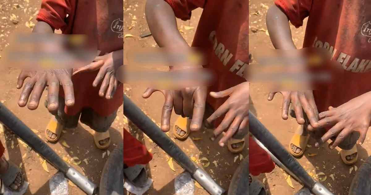 "Which one is the middle finger ?" – Man astonished to discover boy with six fingers (WATCH)