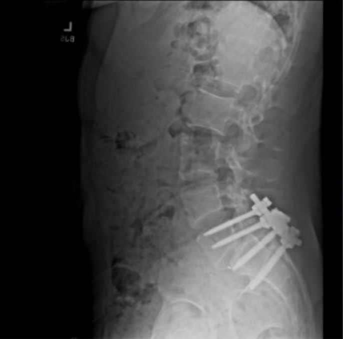 A picture which appears to show four screws in Mangione's back