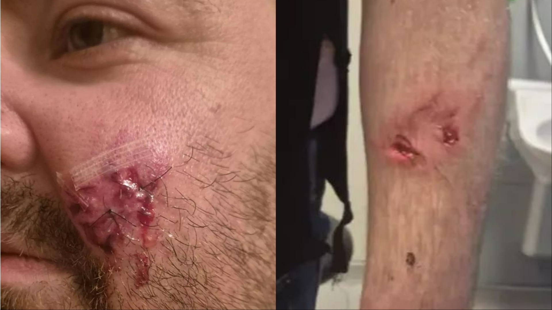 Man left 'scarred for life' after being bitten by XL Bully in brutal attack while taking bins out at Scots flats